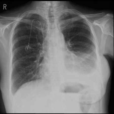 Malignant pleural effusion