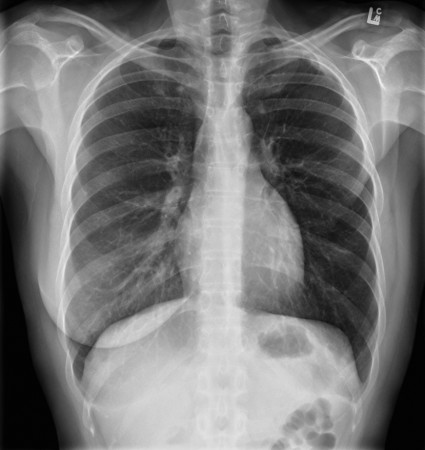 Mastectomy – CXR