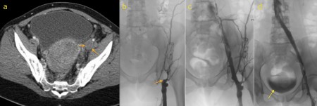 Venous thrombolysis