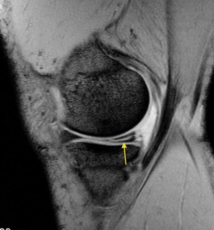 Meniscal tear