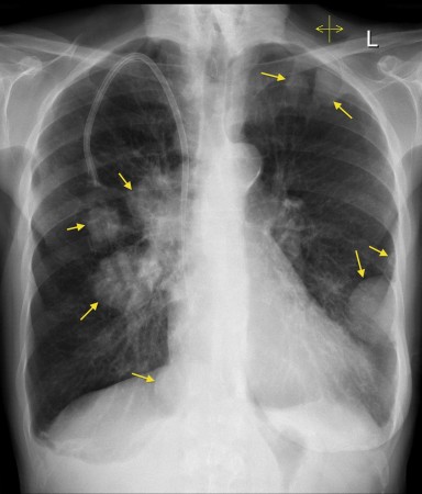 Lung metastases – breast cancer