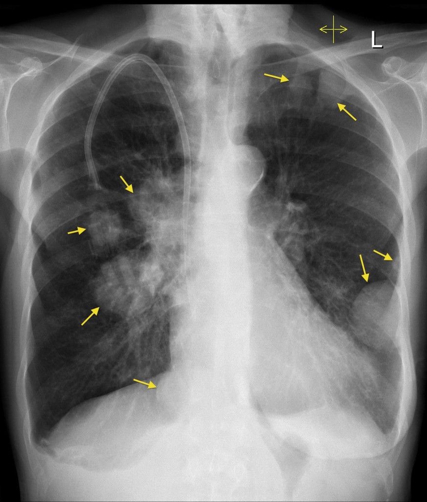 Lung Metastases Breast Cancer Radiology At St Vincents University