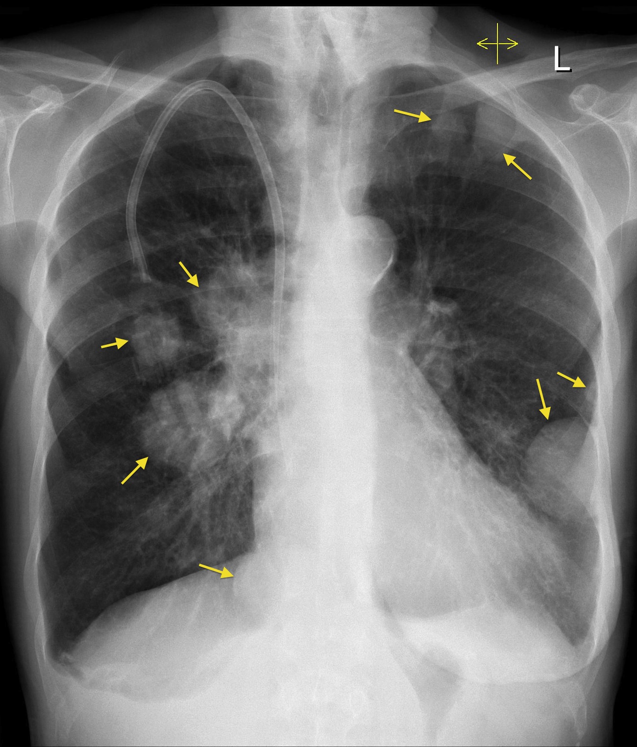 metastatic malignancy