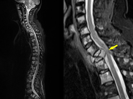 Cord compression – multiple myeloma