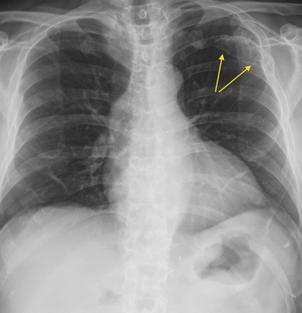 Myeloma in rib