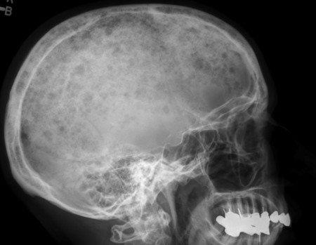 Myeloma