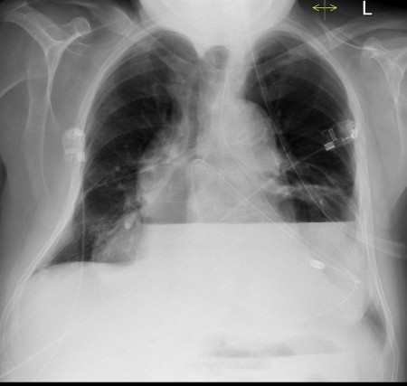 NG tube coiled in hiatus hernia