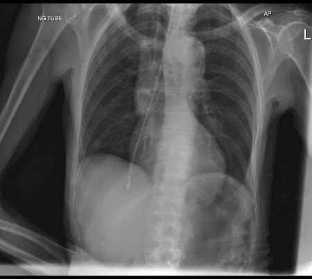 Malpositioned nasogastric tube