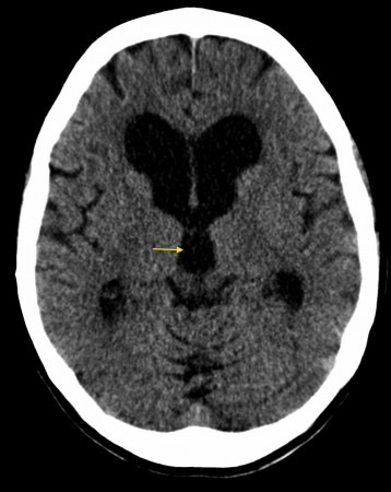 Normal pressure hydrocephalus