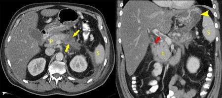 Necrotizing Pancreatitis