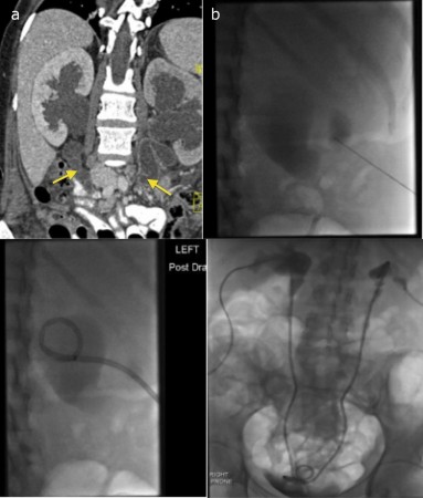 Percutaneous nephrostomy