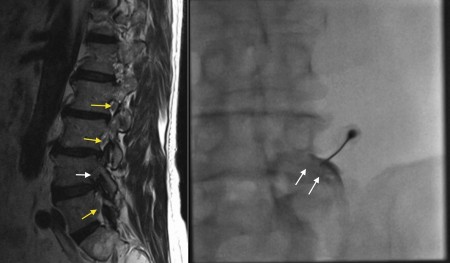 Lumbar transforaminal nerve block