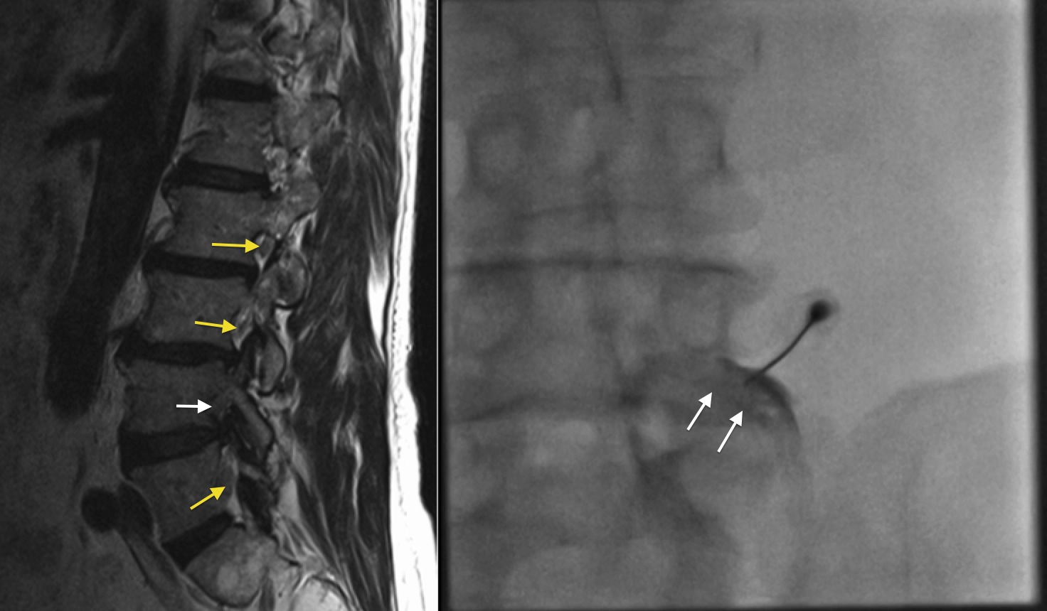 Lumbar transforaminal nerve block Radiology at St. Vincent's University Hospital