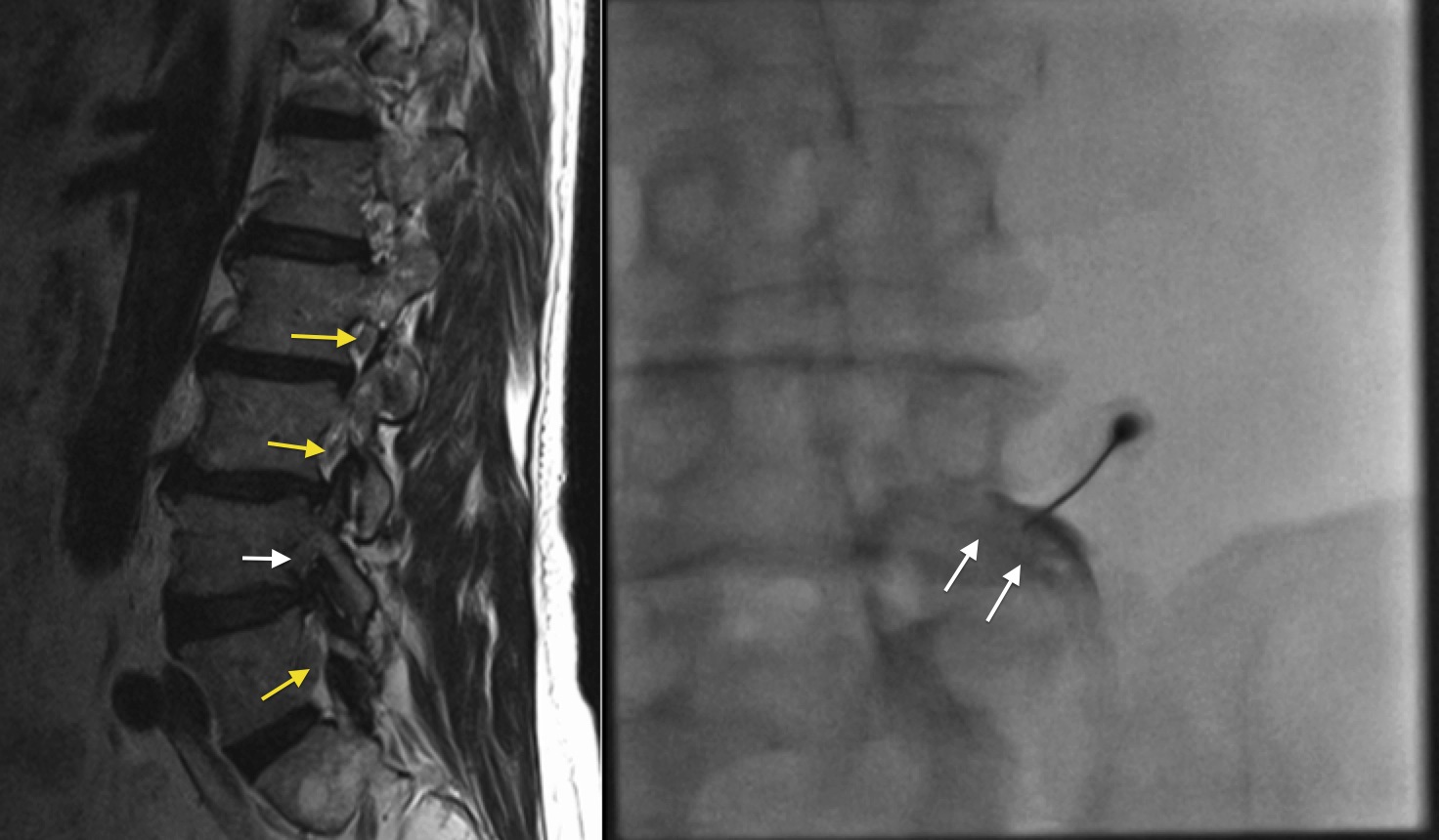 Lumbar transforaminal nerve block - Radiology at St. Vincent's