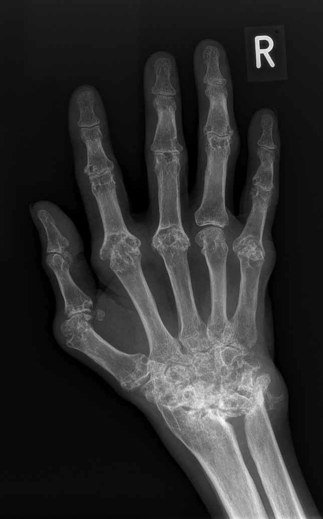 rheumatoid arthritis radiopaedia