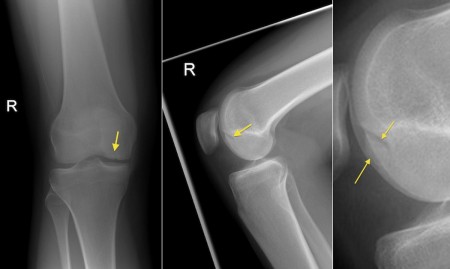 Osteochondral defect, knee