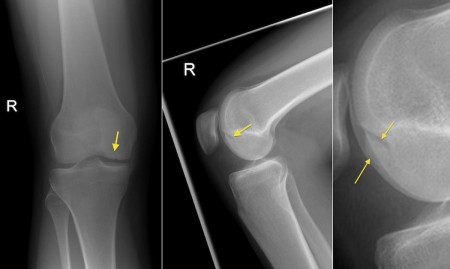 knee osteochondral defect radiology svuhradiology ie