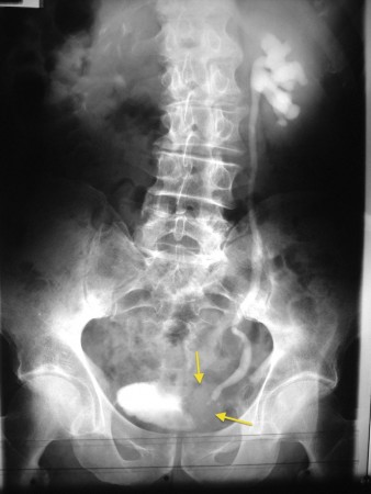 Obstructing bladder TCC