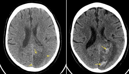 Haemorrhagic transformation of CVA