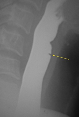 Oesophageal web