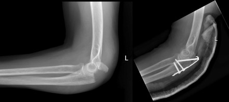 Olecranon fracture