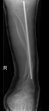 Osteogenesis Imperfecta