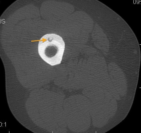 Osteoid osteoma