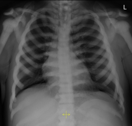 Osteopetrosis