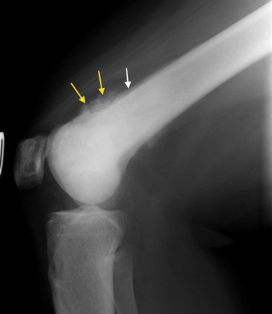 Osteosarcoma