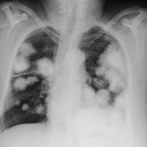 Lung metastases from head and neck cancer Radiology at St.
Vincent\u002639;s University Hospital