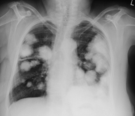 Lung metastases (2)