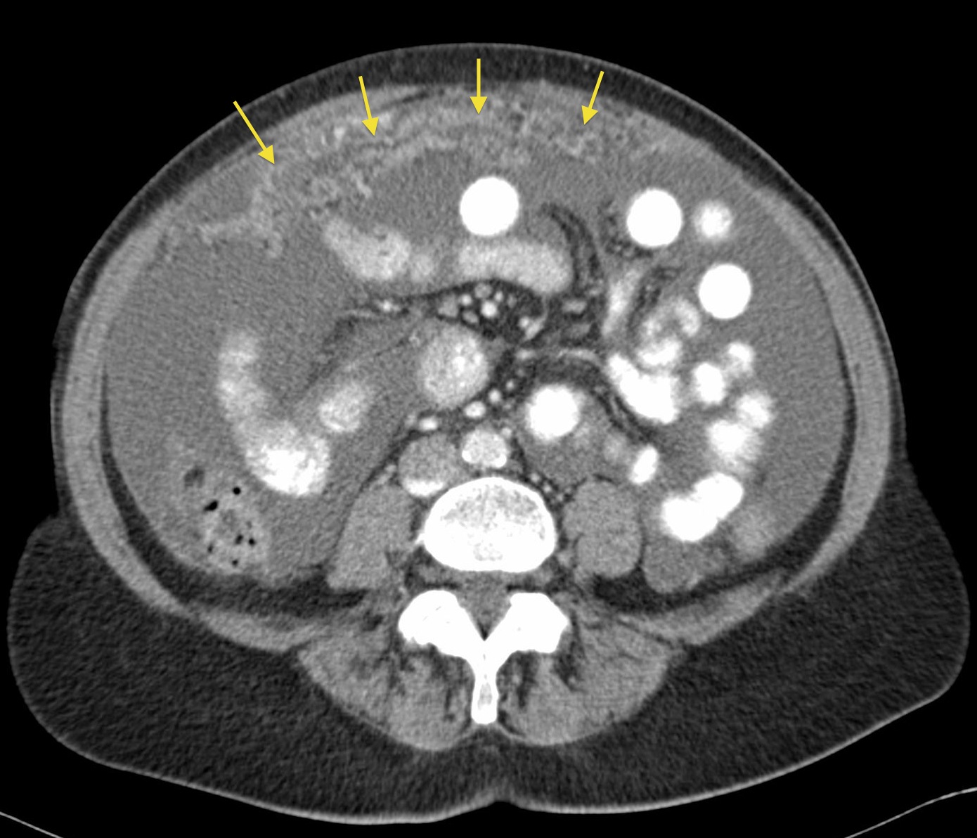 Peritoneal carcinomatosis - Radiology at St. Vincent's University Hospital