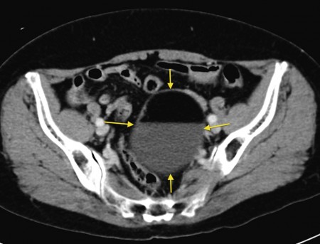 Ovarian dermoid