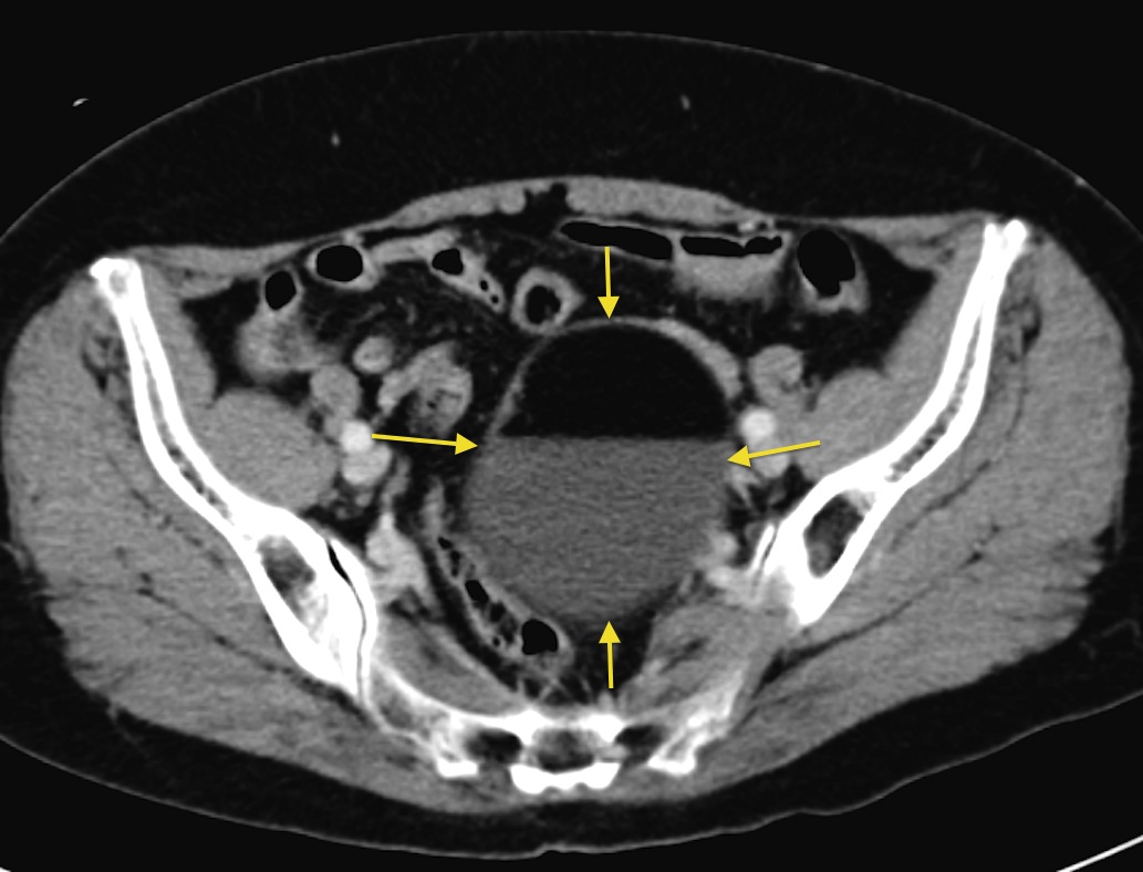 Ovarian dermoid Radiology at St. Vincent's University