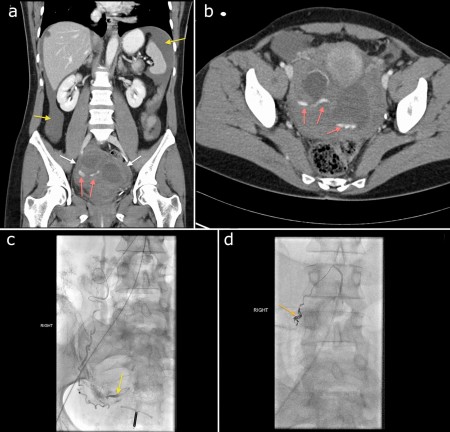 Pelvic embolization