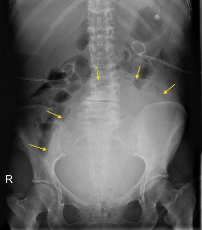 Ovarian carcinoma – PFA