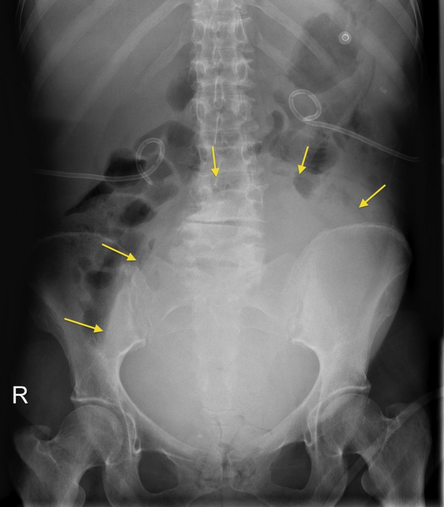 Ovarian cancer ct scan, Cancer risk abdominal ct scan, Ovarian cancer on ct scan