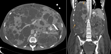 Polycystic Kidney Disease (2)