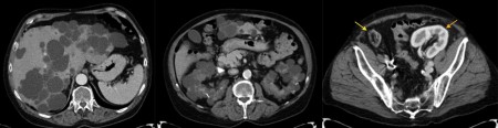 Polycystic Kidney Disease