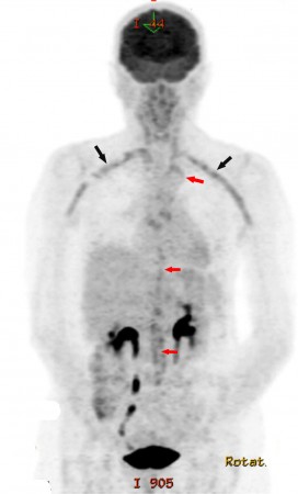 Vasculitis – PET