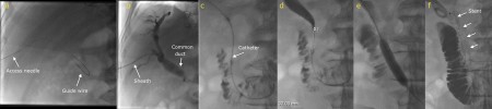 Biliary drainage and stenting