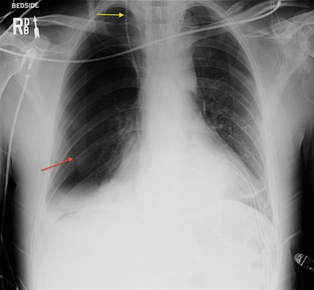 Pneumothorax due to CV line