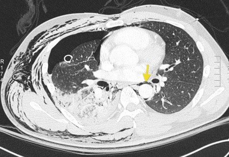 Pneumothorax and subcutaneous emphysema – CT