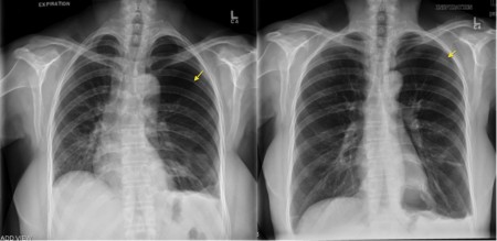 Pneumothorax – expiration