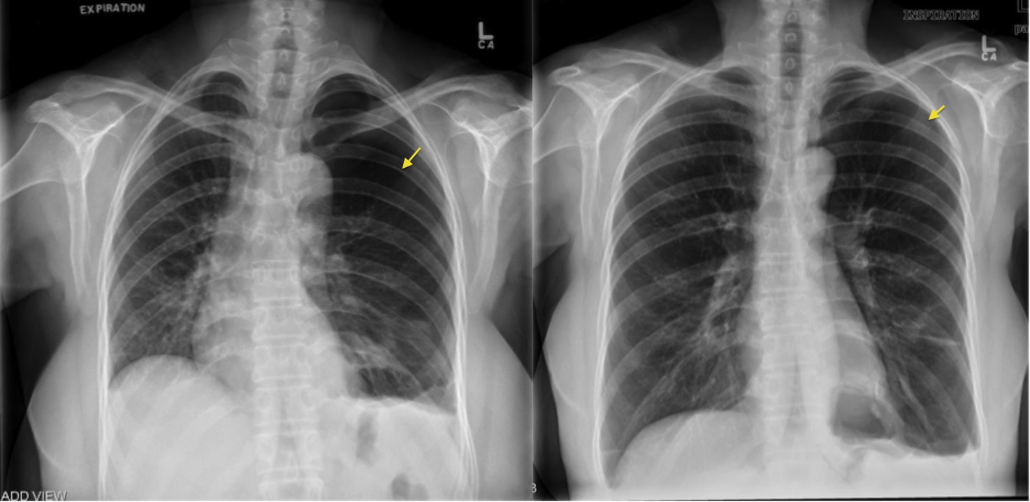 Pneumothorax Expiration Radiology At St Vincent s University Hospital pneumothorax-expiration-radiology-at-st-vincent-s-university-hospital