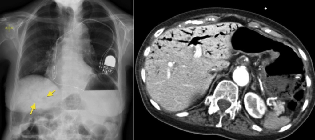 Portal venous gas - Radiology at St. Vincent's University Hospital