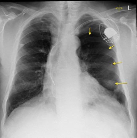 Pneumothorax post pacemaker insertion