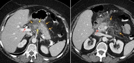 Acute pancreatitis