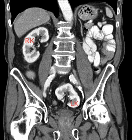 Pelvic kidney