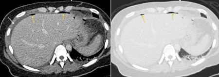 Free intraperitoneal gas – CT